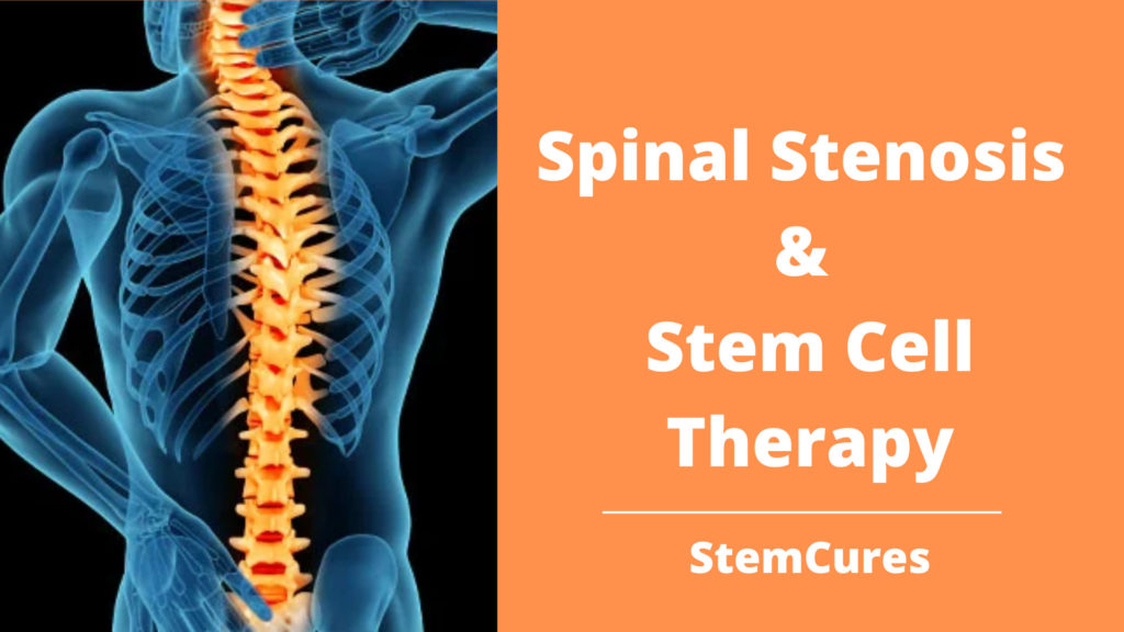 Stem Cell Therapy for Spinal Stenosis | StemCures